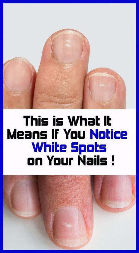 Incredible What Does White Marks On Nail Mean Ideas Inya Head