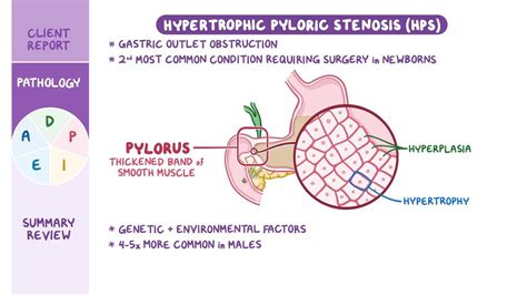Pyloric Stenosis Nursing Process Adpie Osmosis Video Library