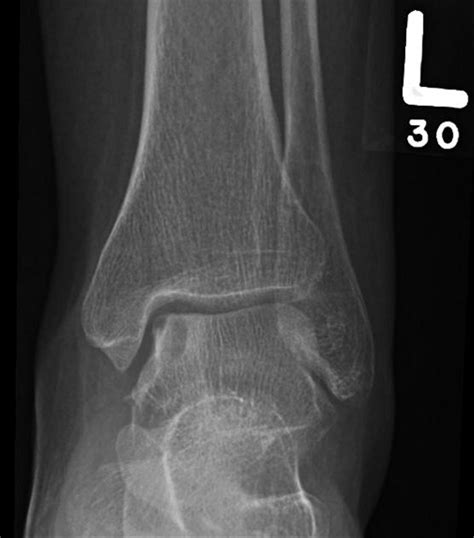 Osteochondral Lesions Of The Talus Foot And Ankle Orthobullets
