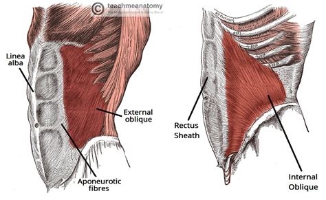 Incisional Hernia Risk Factors Clinical Features Teachmesurgery