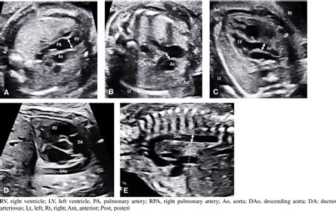 Measurements Of The Fetal Cardiac Parameters In The Right Ventricular