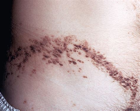 Acd A Z Of Skin Epidermal Naevus