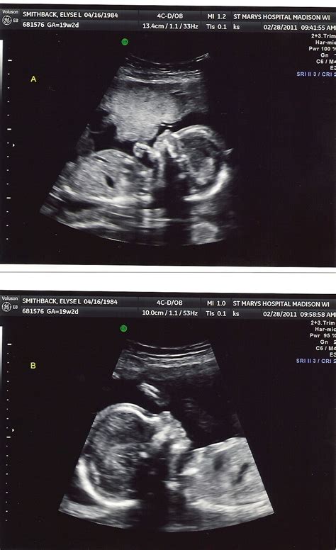 10 Week Ultrasound Identical Twins