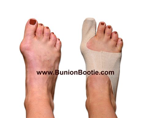 Yet, as unpleasant as bunions are, there are several things you can do to help prevent them, or at least to keep them a bunion is a bony, usually painful bump that sticks out of the joint that connects your big toe to your foot. Newest & Best Natural Bunion Treatment; Bunion Bootie