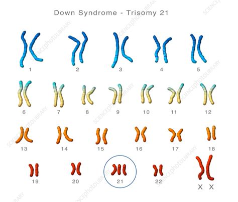 down syndrome karyotype illustration stock image c055 5369 science photo library