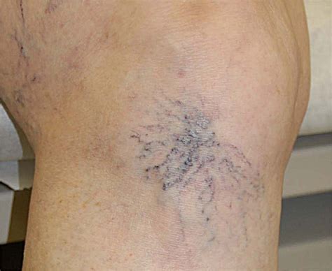 How Much Does Varicose Vein Treatment Cost Without Insurance Answer