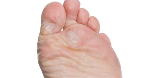 Conditions We Treat Burbank Podiatrist Los Angeles Foot And Ankle Center