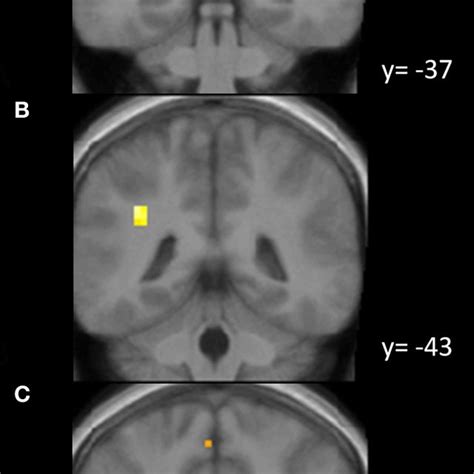 Activations In The Parietal Lobe A Activation In The Right Inferior