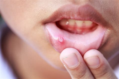 Dealing With Canker Sores A Dentist Discusses Prevention And Treatment