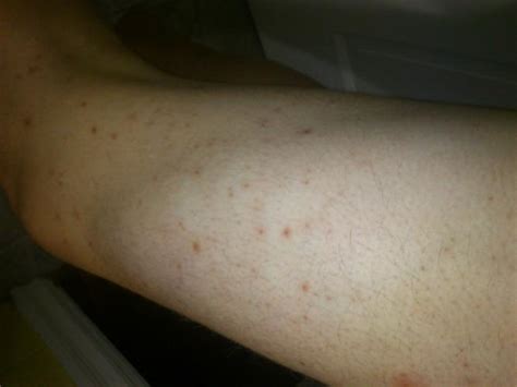 Scars Red Marks On Legs From Shaving Hyperpigmentation Reddark