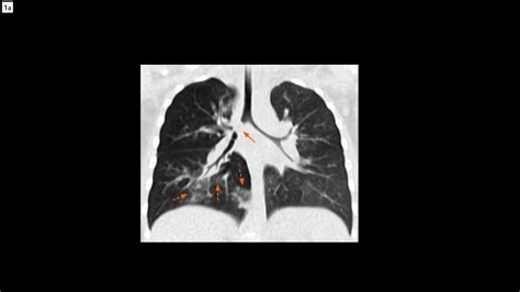 Bronchial Foreign Body Aspiration Siemens Healthineers Usa