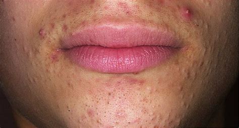 Why Do I Get Pimple Near My Lips