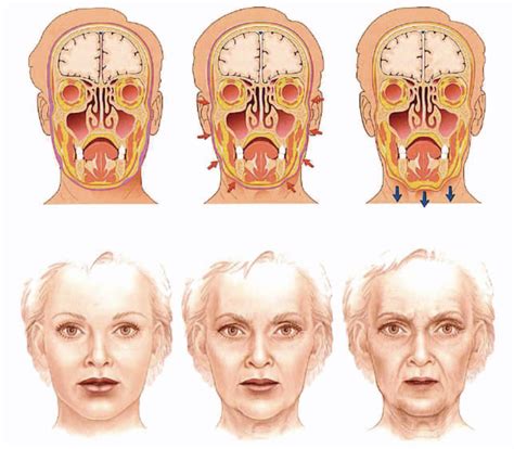 Figure 1 From The Anatomy Of The Aging Face Volume Loss And Changes In