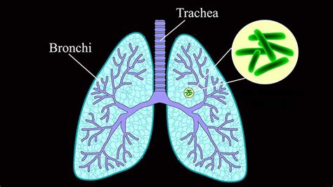 The bacteria that cause tuberculosis are spread from person to person through tiny droplets released into the air. What Is Tuberculosis? | Everyday Health