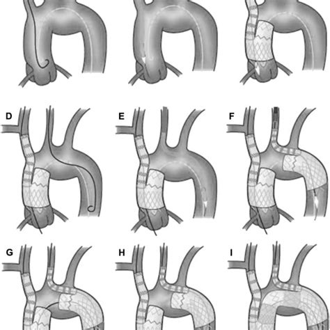 A “normal Aortic Arch” Anatomy B “bovine Aortic Arch” C