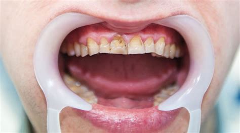 Dental Fluorosis Too Much Fluoride White Spots On Teeth