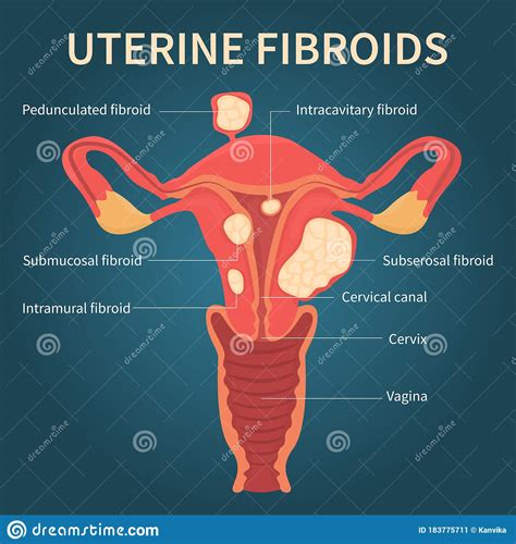 Uterus & Types Of Fibroids Vector Illustration | CartoonDealer.com