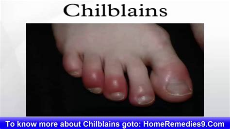 Chilblains Causes Symptoms And Treatment Of Chilblains Youtube