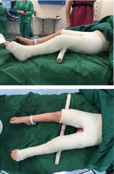 Figure 2 From Foam Splint Versus Spica Cast—early Mobilization After Hip Reconstructive Surgery