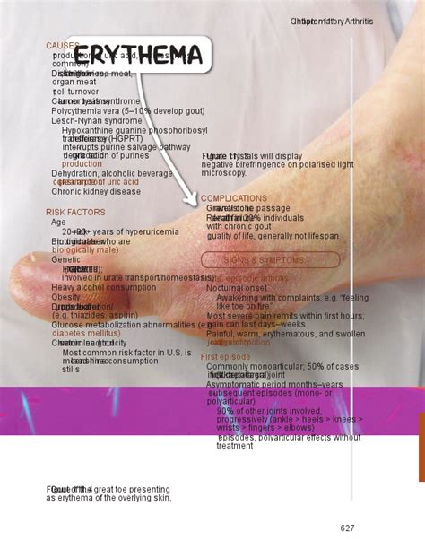Rheumatoid Arthritis Osmosis