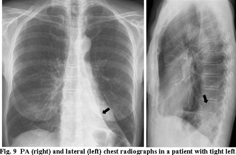Figure 9 From Radiology Corner Tight Left Upper Lobe Collapse From