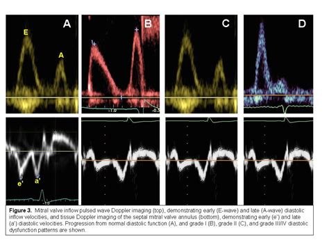 What Is Grade Ii Lv Diastolic Dysfunction Natural Resource Department