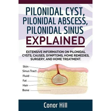 Pilonidal Cyst Fast Healing Guide Fast Track Guide To Pilonidal Cyst