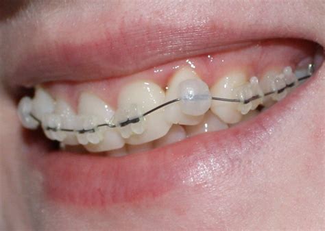 How To Use Orthodontic Wax For Braces How To Apply Dental Wax On