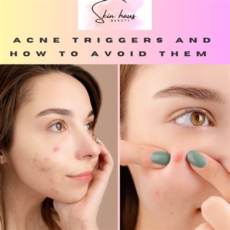 Skinhausng On Twitter Acne Triggers And How To Avoidcontrol Them Here