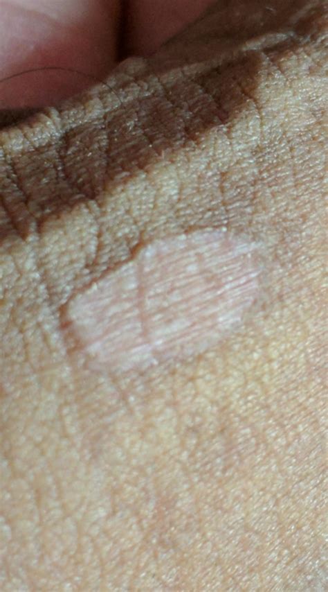 Unusual Dead Skin On The Penis Causes And Concerns Heidi Salon