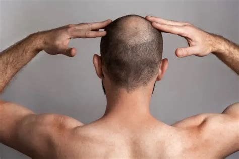 7 Early Signs Of Balding Causes And Next Steps Bald And Beards