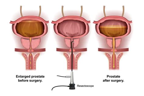 Transurethral Resection Of The Prostate Dr Anand Arumugam