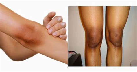 15 Effective Tips To Get Rid Of Black Knees And Elbow Blemish Remedies