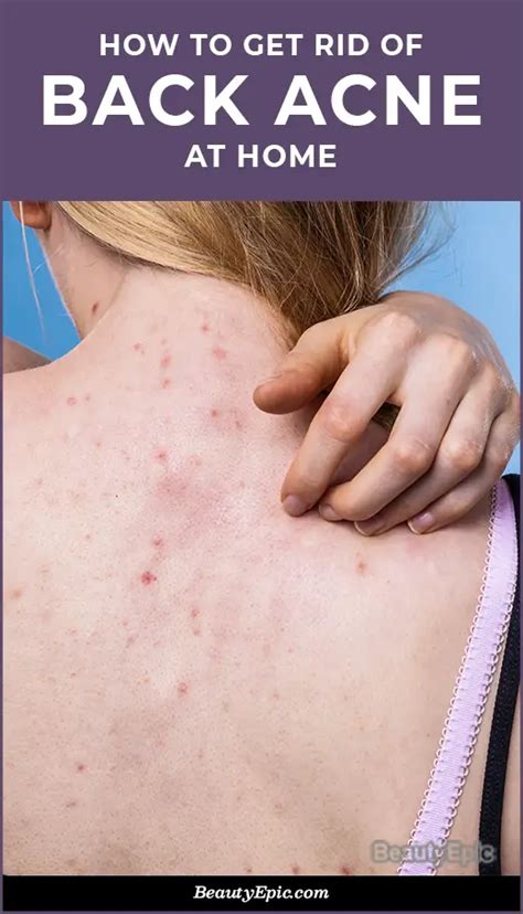 How To Get Rid Of Back Acne Fast Naturally