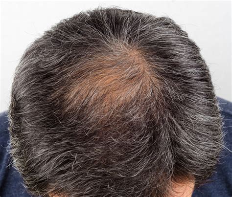 Male Pattern Baldness Advanced Regenerative Health