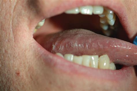 Oral Hairy Leukoplakia Arising In A Patient With Hairy Cell Leukaemia The First Reported Case