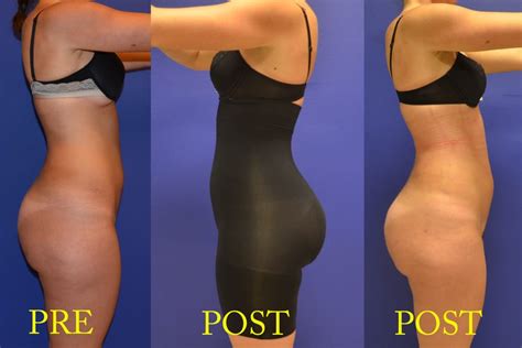 Subtle But Beautiful Result With Brazillian Butt Lift View Of Postoperative Compression Garment
