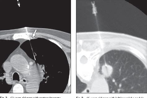 Pdf Ct Guided Percutaneous Needle Biopsy Of The Chest Preprocedural