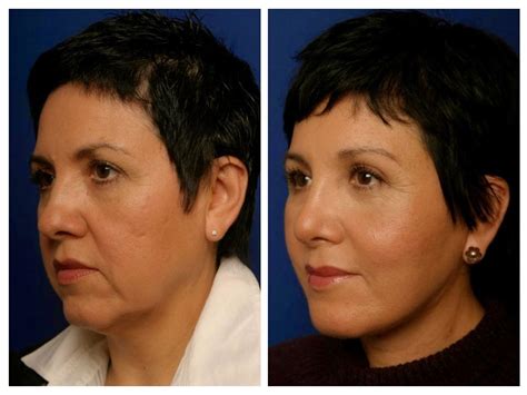 Medical Treatment Pictures For Better Understanding Chin Lift Surgery