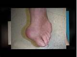 Images of Medical Condition Gout