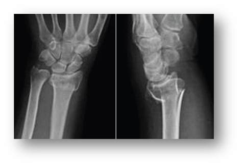 Distal Radius Fracture Canberra Hand Centre