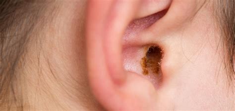 Wax Off Tackling Earwax Blockage Head On Happiest Health