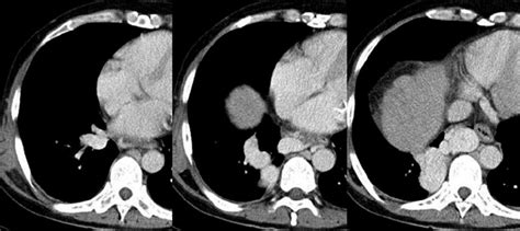 Contrast Enhanced Chest Ct Reveals That The Markedly Engorged