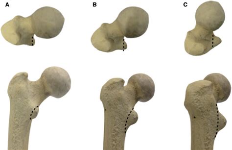 Figure 2 From Endoscopic Lesser Trochanter Resection For Treatment Of