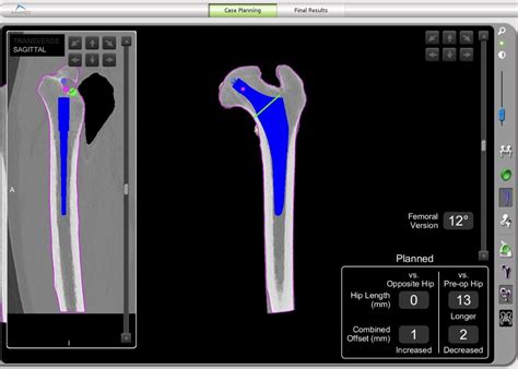 Robotic Hip Replacement Leeds Joint Replacements