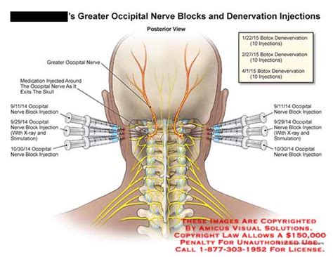 Greater Occipital Nerve Block Anatomy My XXX Hot Girl