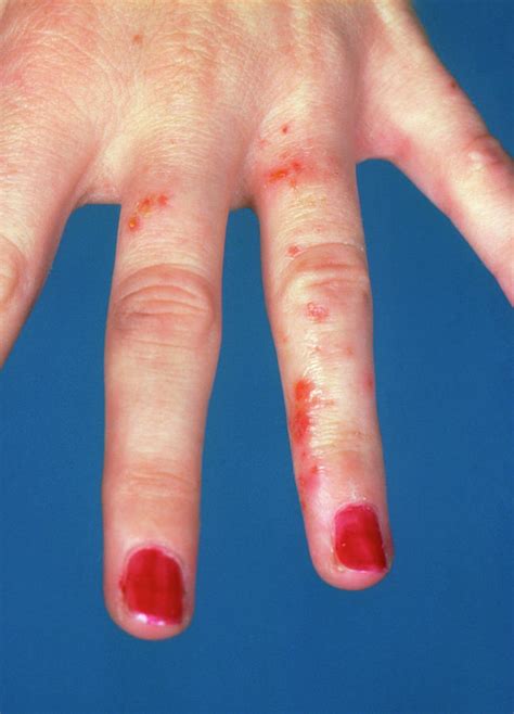 Contact Dermatitis Hands