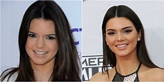 Cirugías de Kendall Jenner (+Antes y Después) - Cirugias.de