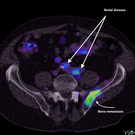 Psma Scan For Prostate Cancer Garran Medical Imaging