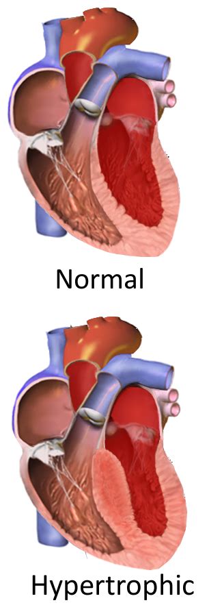 Cardiomiopatia hipertrófica Wikipédia a enciclopédia livre